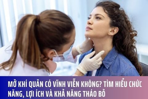 Mở khí quản có vĩnh viễn không? Tìm hiểu chức năng, lợi ích và khả năng tháo bỏ