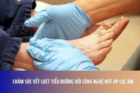 Chăm Sóc Vết Loét Tiểu Đường với Công Nghệ Hút Áp Lực Âm