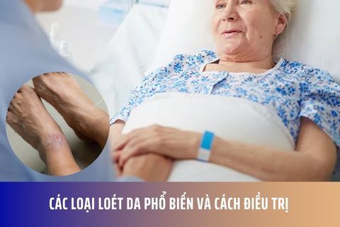 Các loại loét da phổ biến và cách điều trị
