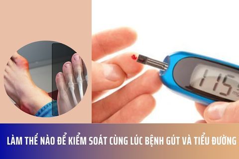 Làm Thế Nào Để Kiểm Soát Cùng Lúc Bệnh Gút và Tiểu Đường