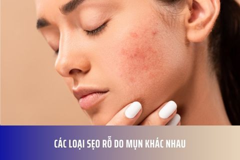 Các Loại Sẹo Rỗ Do Mụn Khác Nhau