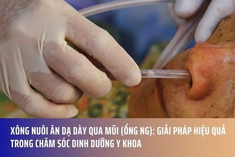 Xông Nuôi Ăn Dạ Dày Qua Mũi (Ống NG): Giải Pháp Hiệu Quả Trong Chăm Sóc Dinh Dưỡng Y Khoa