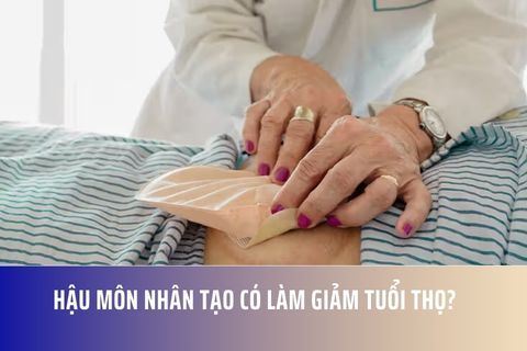 Hậu Môn Nhân Tạo Có Làm Giảm Tuổi Thọ?