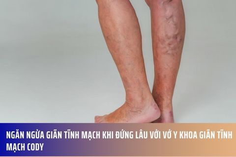 Ngăn Ngừa Giãn Tĩnh Mạch Khi Đứng Lâu Với Vớ Y Khoa Giãn Tĩnh Mạch Cody