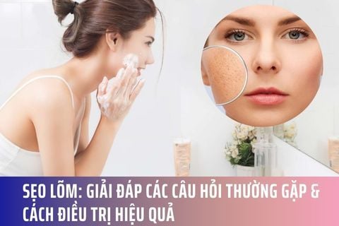 Sẹo Lõm: Giải Đáp Các Câu Hỏi Thường Gặp & Cách Điều Trị Hiệu Quả