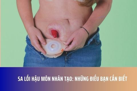 Sa Lồi Hậu Môn Nhân Tạo: Những Điều Bạn Cần Biết