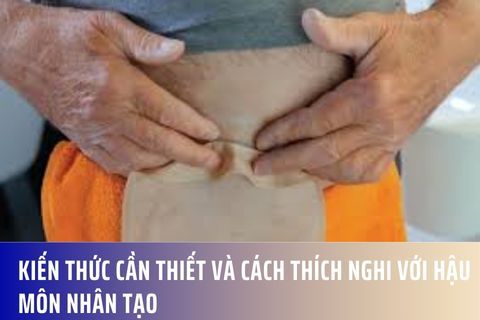 Kiến Thức Cần Thiết và Cách Thích Nghi với Hậu môn nhân tạo