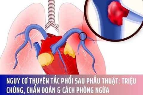 Nguy cơ Thuyên Tắc Phổi Sau Phẫu Thuật: Triệu Chứng, Chẩn Đoán & Cách Phòng Ngừa