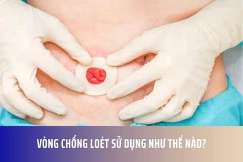 Vòng chống loét sử dụng như thế nào?