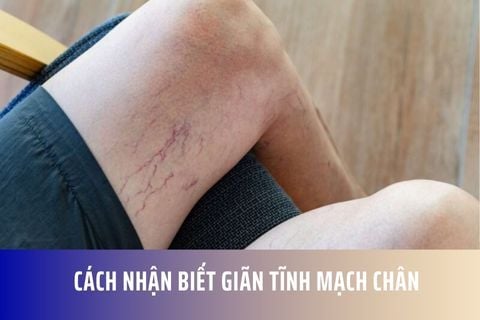 Cách nhận biết giãn tĩnh mạch chân
