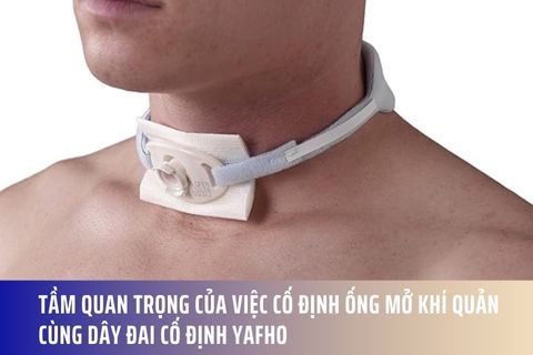 Tầm quan trọng của việc cố định ống mở khí quản cùng Dây đai cố định Yafho