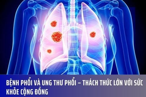 Bệnh phổi và ung thư phổi – Thách thức lớn với sức khỏe cộng đồng