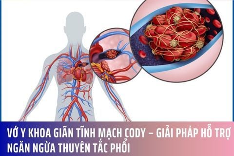 Vớ Y Khoa Giãn Tĩnh Mạch Cody – Giải Pháp Hỗ Trợ Ngăn Ngừa Thuyên Tắc Phổi