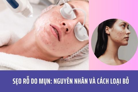 Sẹo Rỗ Do Mụn: Nguyên Nhân Và Cách Loại Bỏ