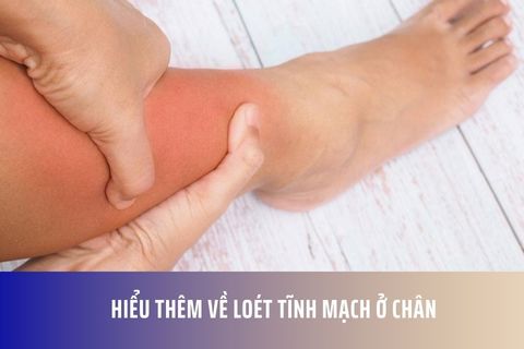 Hiểu Thêm Về Loét Tĩnh Mạch ở Chân