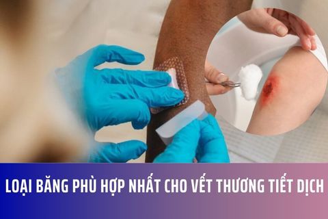 Loại băng phù hợp nhất cho vết thương tiết dịch