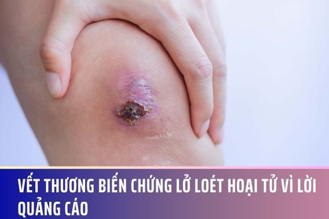 Vết thương biến chứng lở loét hoại tử vì lời quảng cáo