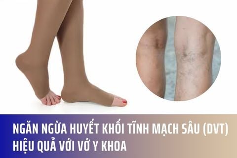 Ngăn ngừa huyết khối tĩnh mạch sâu (DVT) hiệu quả với Vớ y khoa