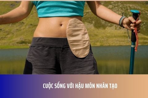 Cuộc sống với Hậu Môn Nhân Tạo