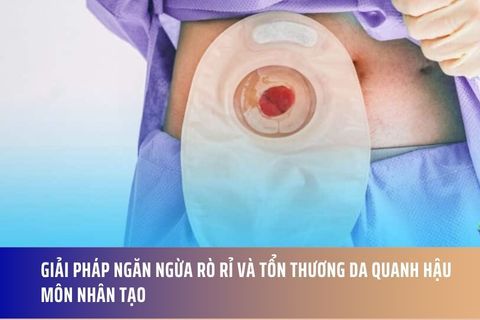 Giải Pháp Ngăn Ngừa Rò Rỉ và Tổn Thương Da Quanh Hậu Môn Nhân Tạo