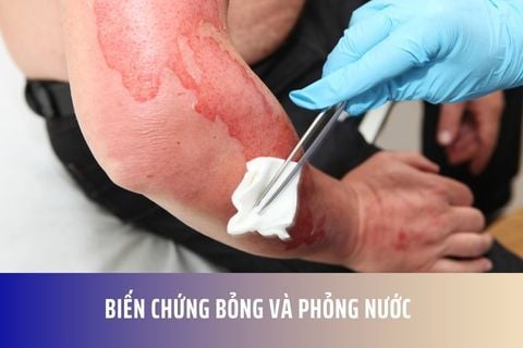 Biến chứng Bỏng và Phỏng nước