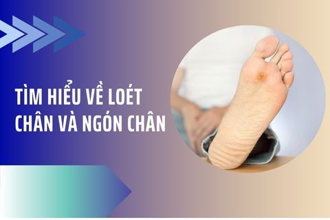 Tìm hiểu về loét chân và ngón chân