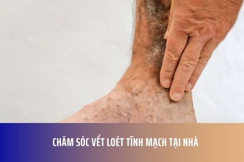 Chăm sóc vết loét tĩnh mạch tại nhà