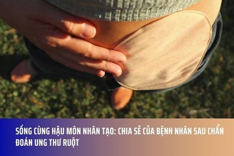 Sống cùng hậu môn nhân tạo: Chia sẻ của bệnh nhân sau chẩn đoán ung thư ruột