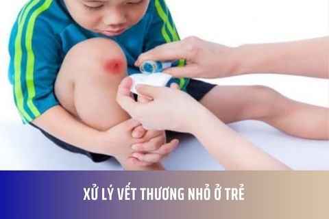 Xử lý vết thương nhỏ ở trẻ