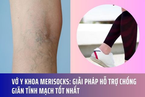 Vớ Y Khoa Merisocks: Giải Pháp Hỗ Trợ Chống Giãn Tĩnh Mạch Tốt Nhất