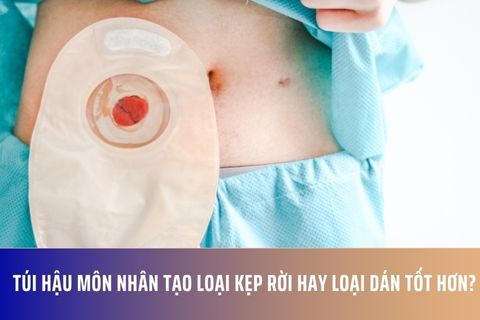 Túi hậu môn nhân tạo loại kẹp rời hay loại dán tốt hơn?