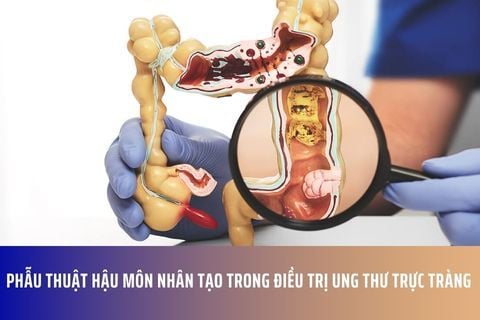 Phẫu thuật hậu môn nhân tạo trong điều trị ung thư trực tràng