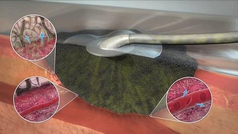 Đóng vết thương bằng chân không để chữa lành vết thương: Hướng dẫn chăm sóc