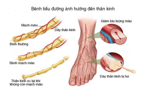 Tại sao đái tháo đường gây loét bàn chân?
