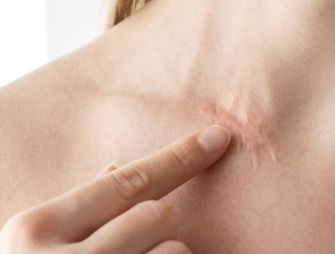GEL SILICON : Sản phẩm tối ưu để chữa lành làn da sau xâm lấn