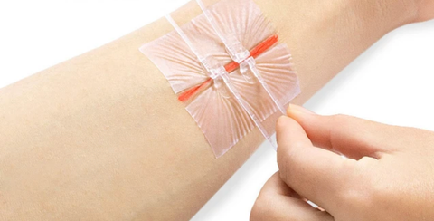 Kỹ thuật đóng vết thương kiểu khoá kéo mới được sử dụng trong các thủ tục phẫu thuật