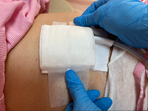 Cách chăm sóc vết thương có ống dẫn lưu