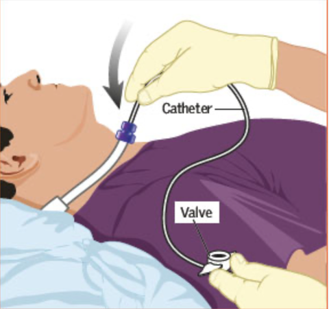 9 bước hướng dẫn hút Dịch Đờm Khí Quản đơn giản