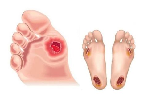 Làm gì khi bạn bị loét da?