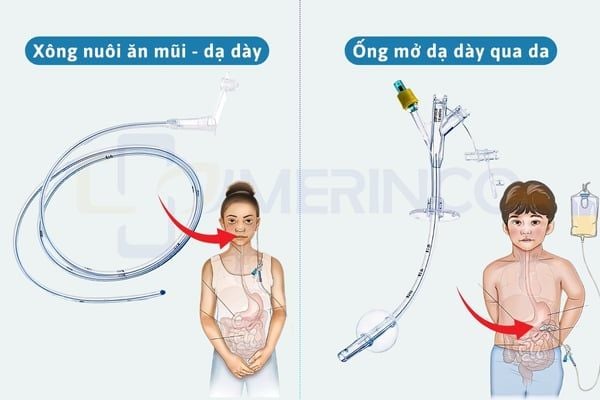 Tổng quan về ống nuôi ăn