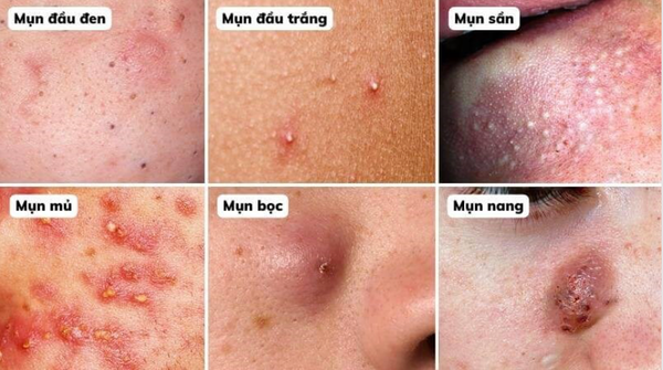 Mụn trứng cá: Nguyên nhân, Các loại và Phương pháp Điều trị Hiệu Quả