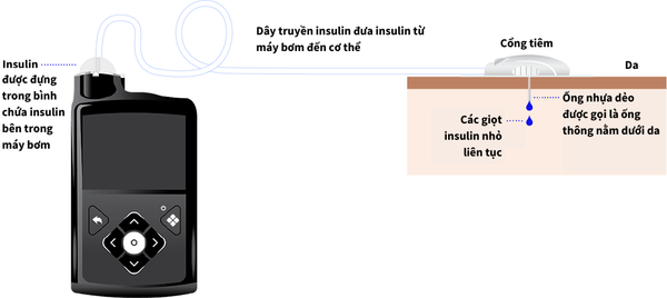Liệu pháp bơm insulin tự động: Một lựa chọn nâng cao trong quản lý bệnh tiểu đường
