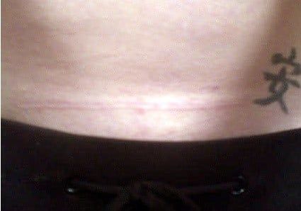 Sẹo mổ sau sinh: Hình ảnh vết mổ sau sinh bị lồi và Cách điều trị