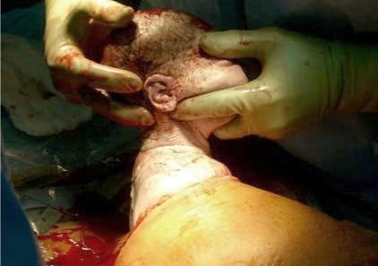 Sẹo mổ sau sinh: Hình ảnh vết mổ sau sinh bị lồi và Cách điều trị