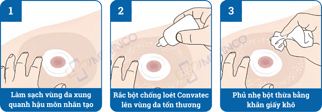 Bột hút ẩm chống loét ConvaTec bảo vệ da quanh hậu môn nhân tạo