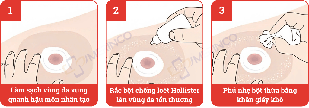 Bột hút ẩm chống loét hậu môn nhân tạo Hollister Adapt Stoma Power 7906