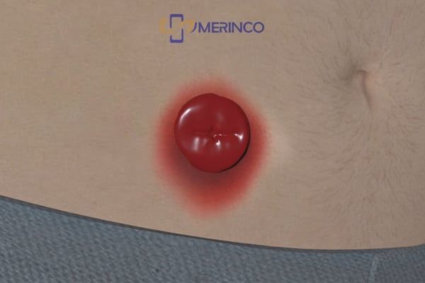 Biến chứng phổ biến của hậu môn nhân tạo: Vấn đề về da và rò rỉ