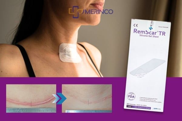 Sẹo tuyến giáp 2 tháng: Dùng miếng dán trị sẹo RemScar TR có hiệu quả? Sẹo tuyến giáp 2 tháng: Dùng miếng dán trị sẹo RemScar TR có hiệu quả?