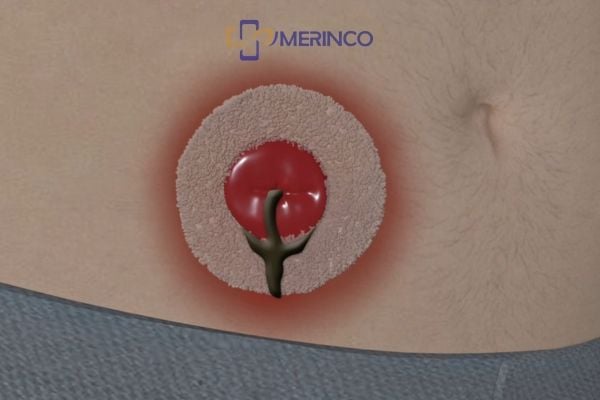 Biến chứng phổ biến của hậu môn nhân tạo: Vấn đề về da và rò rỉ