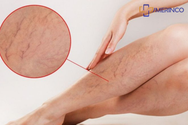 Suy giãn tĩnh mạch thai kỳ
